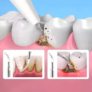 Royaleva Ultrasonic Scaler for Home Use 3