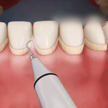 Novara Ultrasonic Tooth Cleaner for Plaque Removal & Home Dental Care